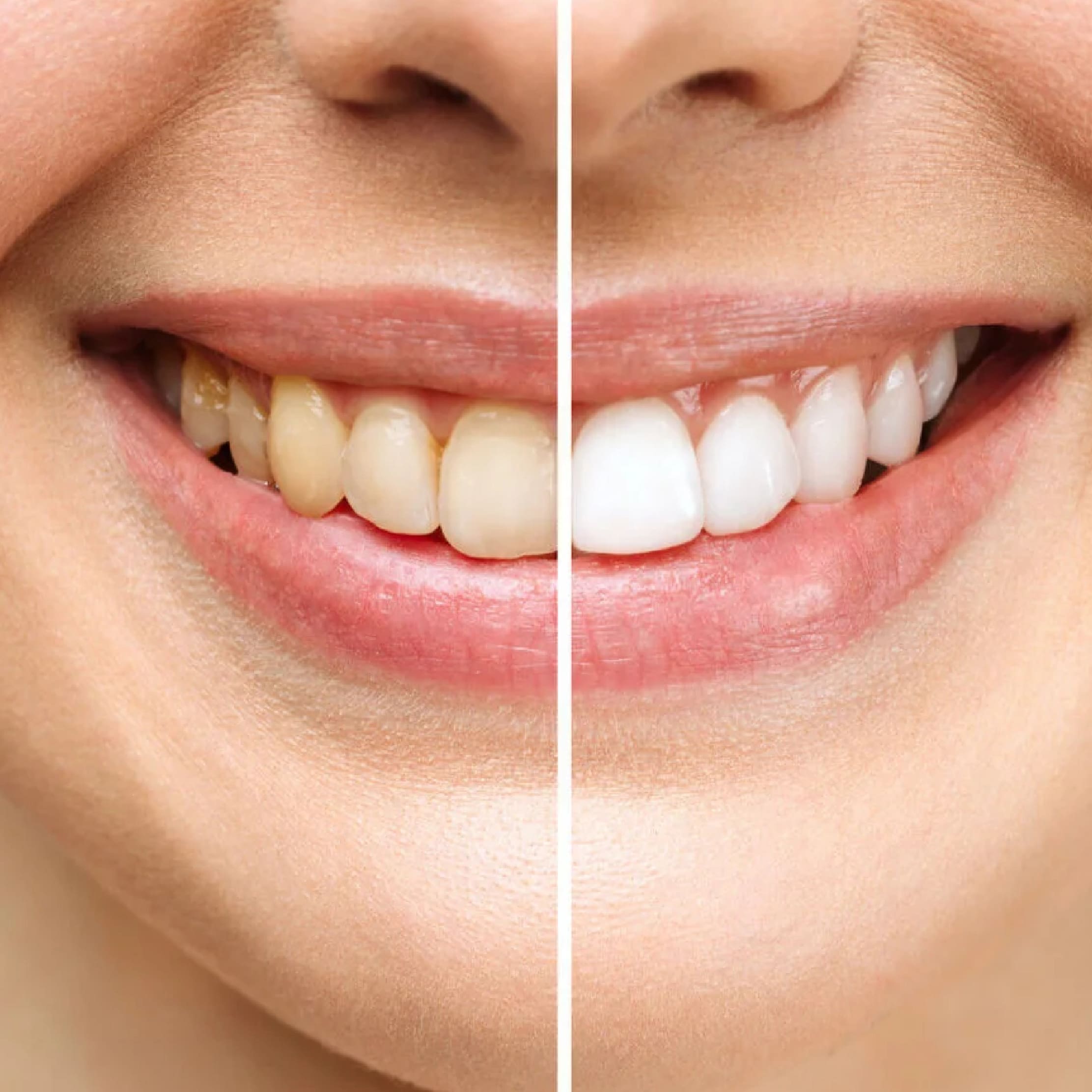 Tratamiento de Estética Dental