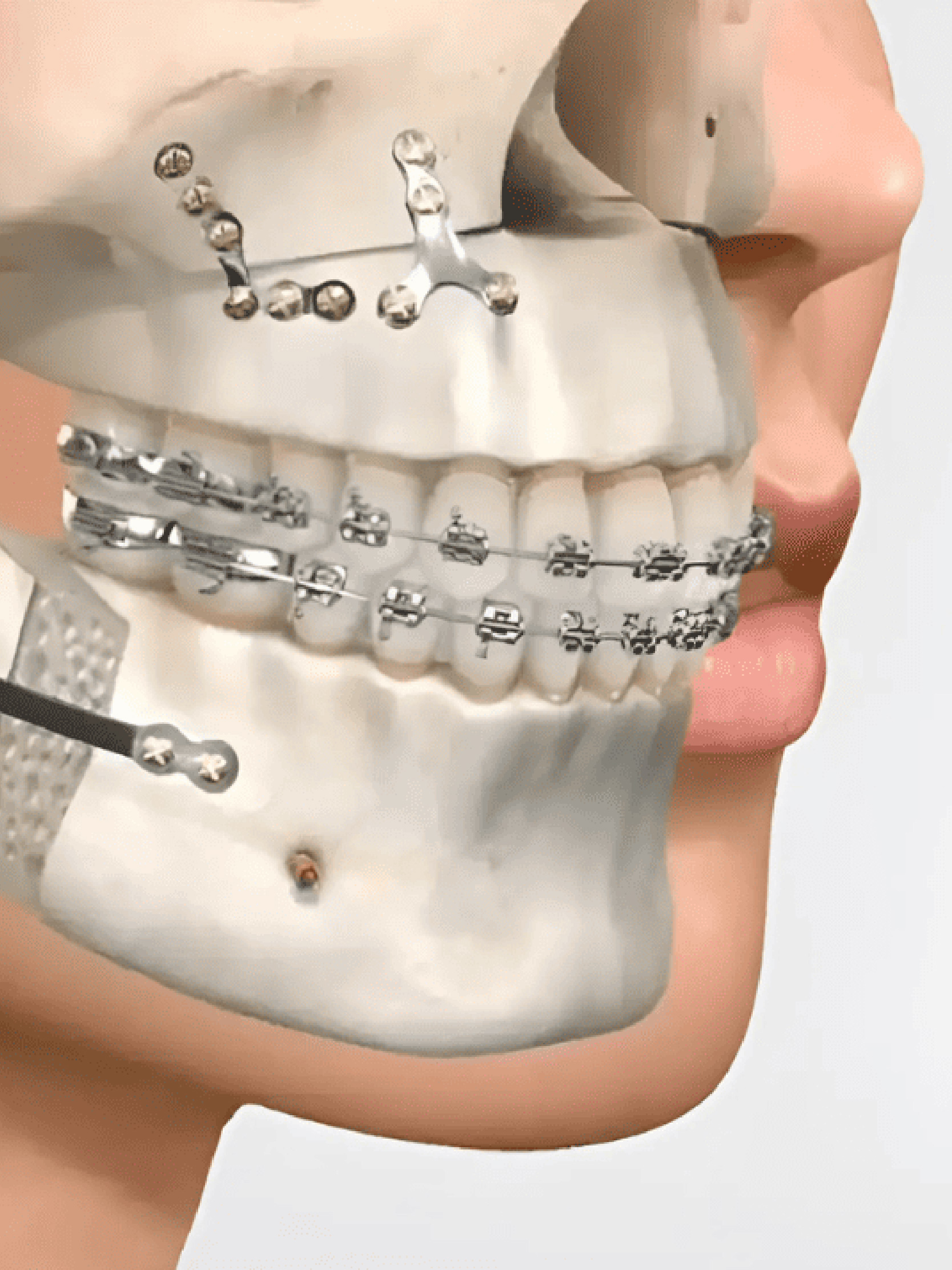 Tratamiento de Cirugía Maxilofacial