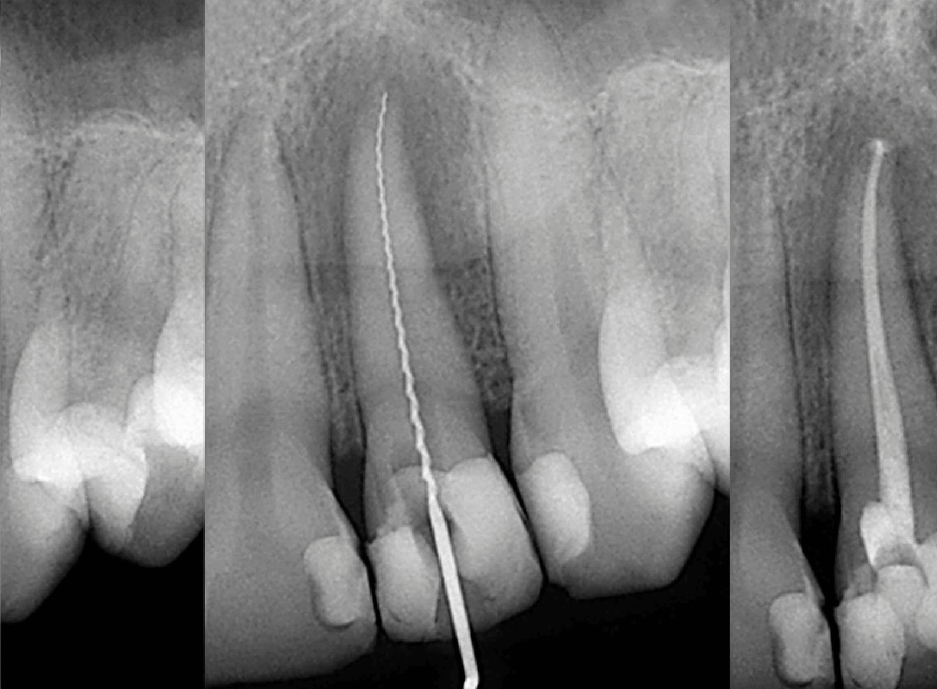 Endodoncias