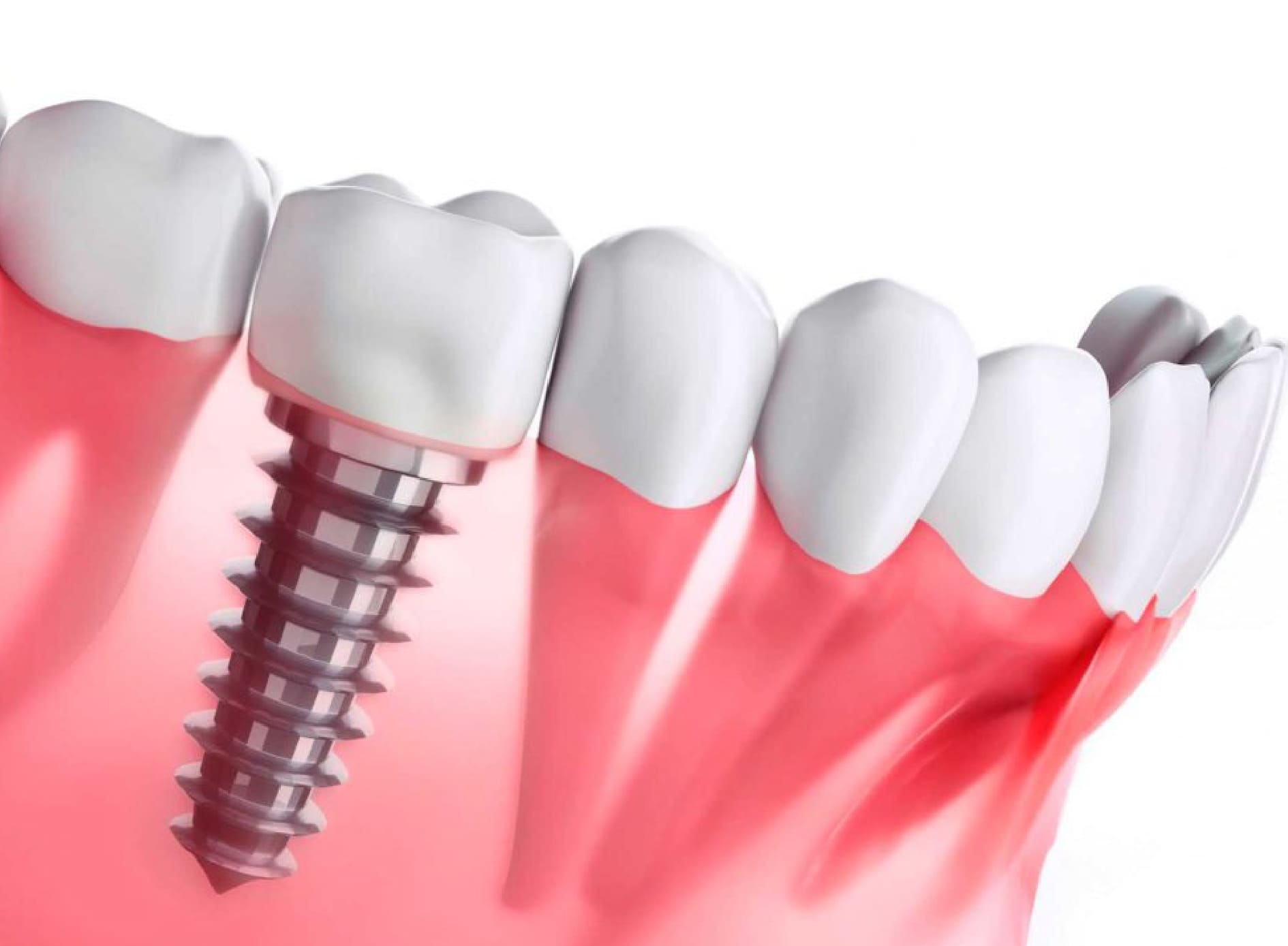 Implantes Dentales