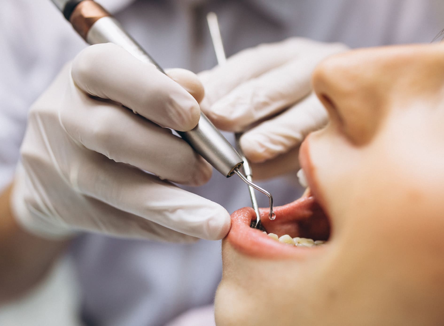 Mantenimiento Periodontal